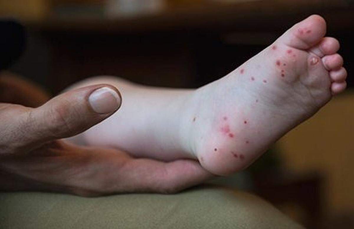 Signs of hand, foot and mouth disease can include a skin rash on hands or feet, as seen in this file photo. Wichita is seeing a spike in cases as cold and flu season approaches.