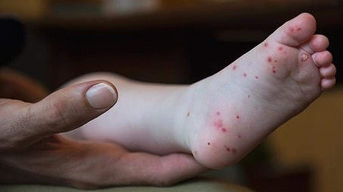 Signs of hand, foot and mouth disease can include a skin rash on hands or feet. Five Western Washington University students have been diagnosed with the disease in the past two weeks, causing the Student Health Center to post a warning on Twitter.