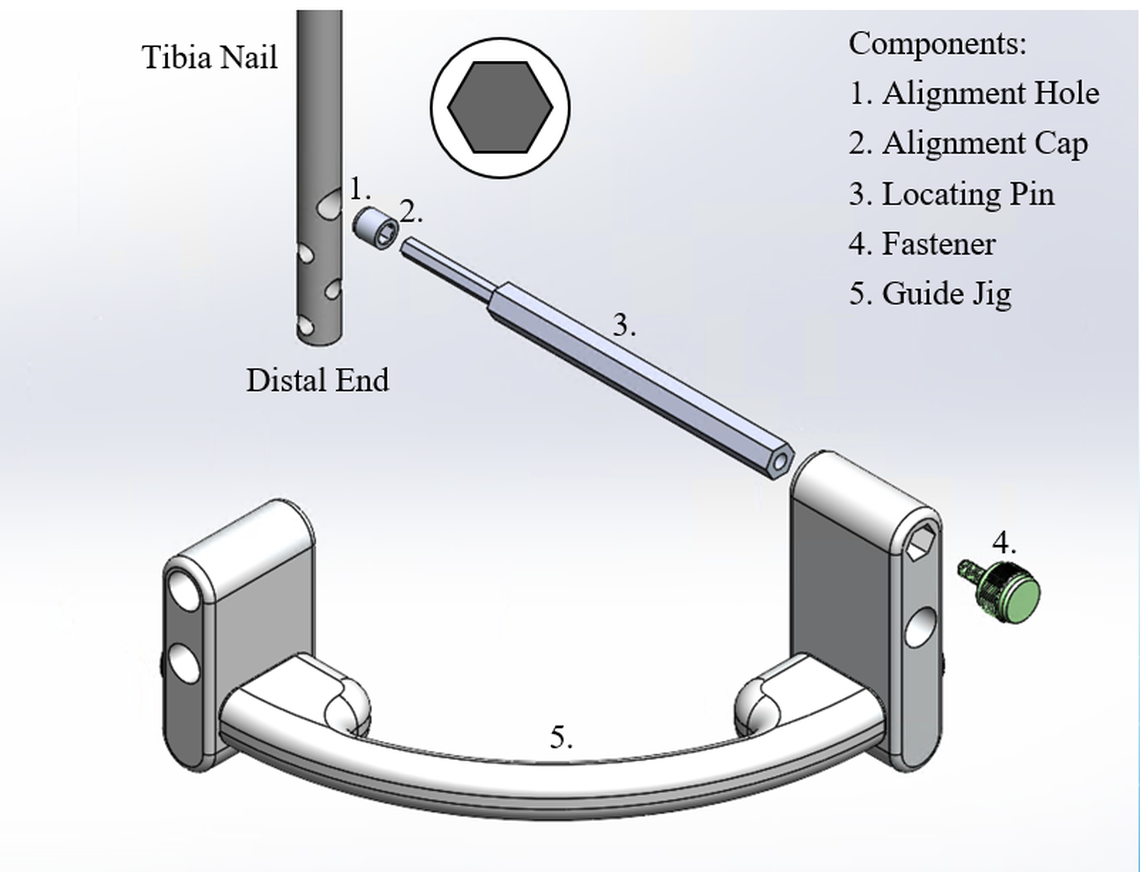 The Distal-Screw Guiding System was patented by a WWU department chair to allow easier surgery for doctors and patients