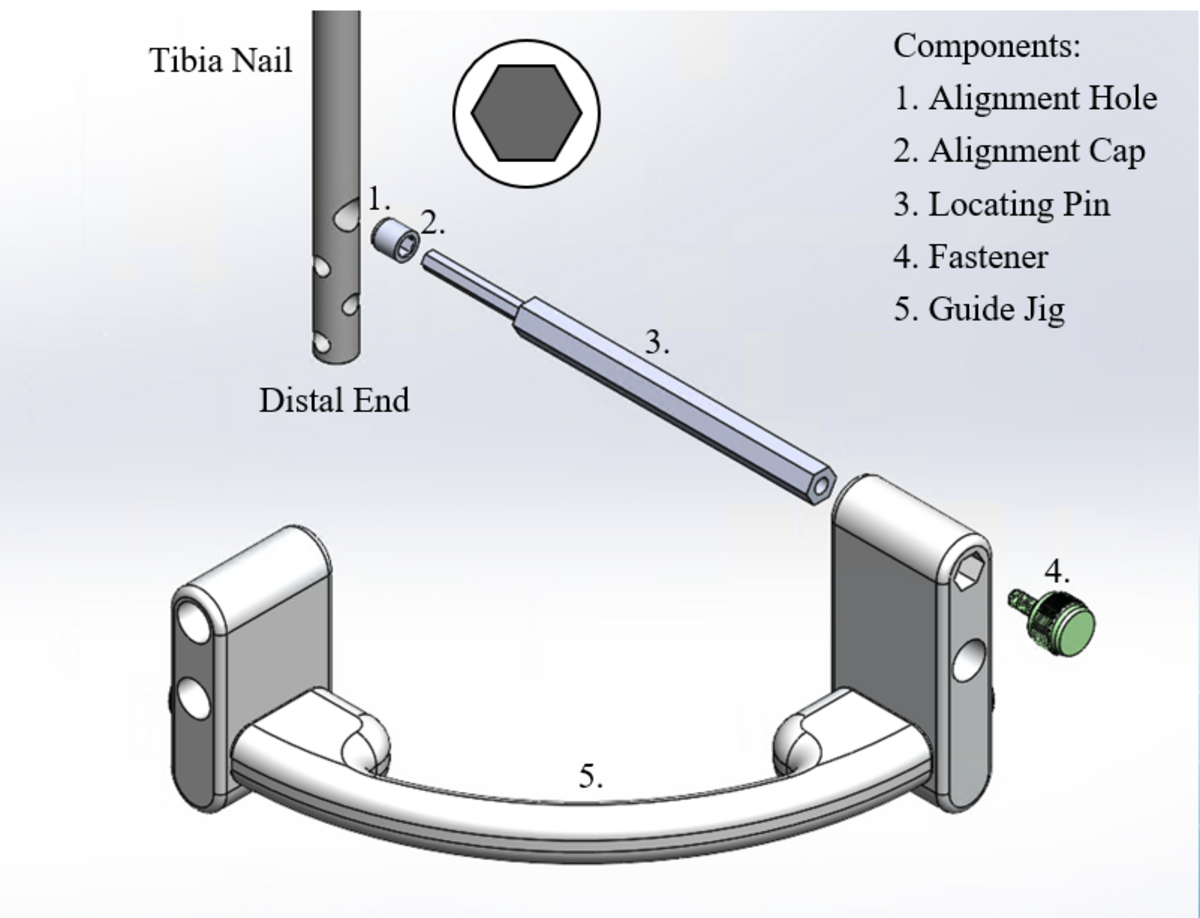 The Distal-Screw Guiding System was patented by a WWU department chair to allow easier surgery for doctors and patients