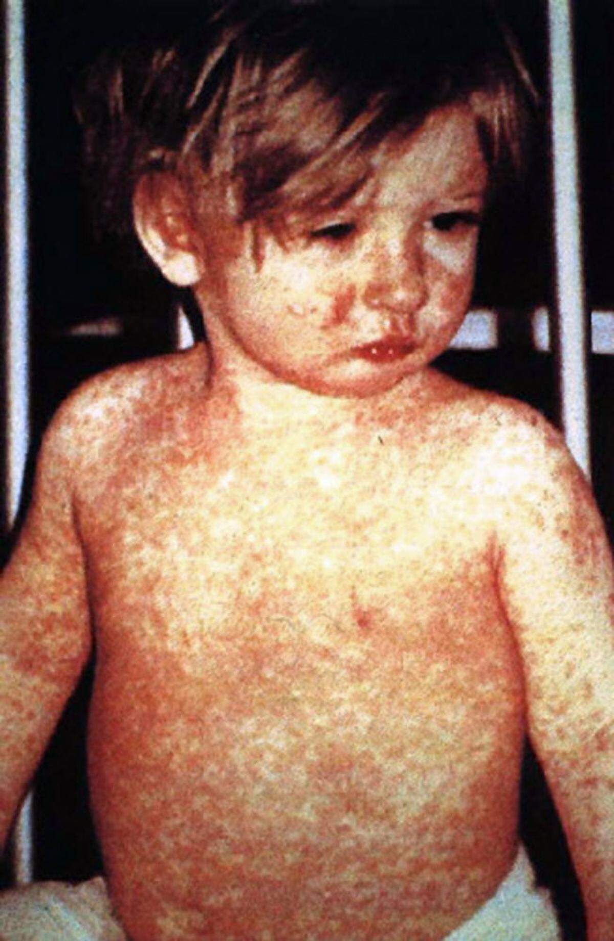 This child shows a classic day-four rash with measles.