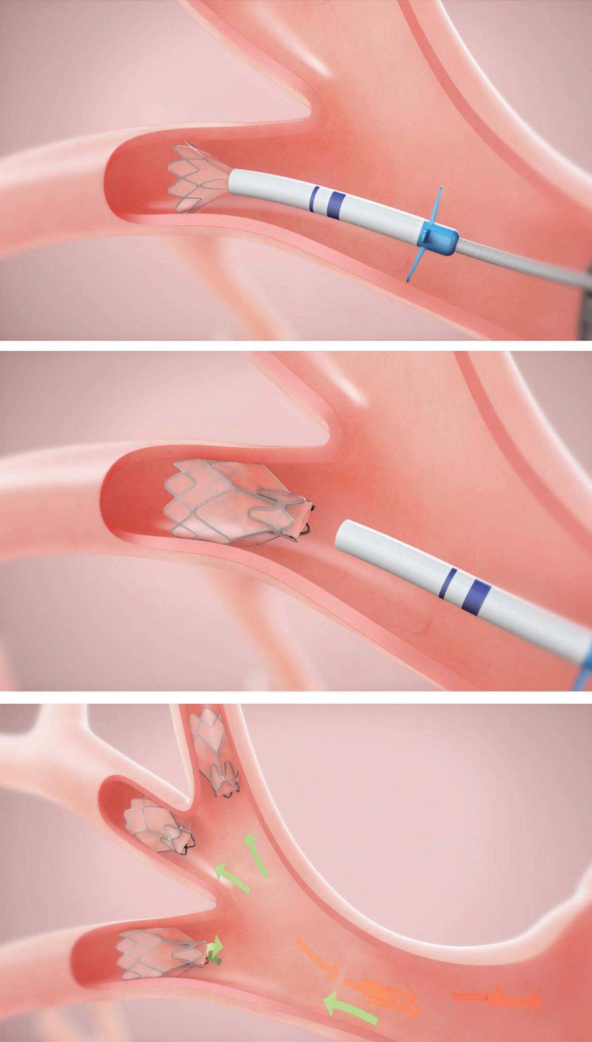 St. Joseph hospital in Bellingham was the first in Washington state to offer Zephyr Endobronchial Valve treatment to help emphysema sufferers breathe easier without major surgery. Tiny valves are placed in the airways during a bronchoscopy that requires no cutting or incisions. They block off diseased parts of the lungs to allow the healthier parts of the lungs to expand.