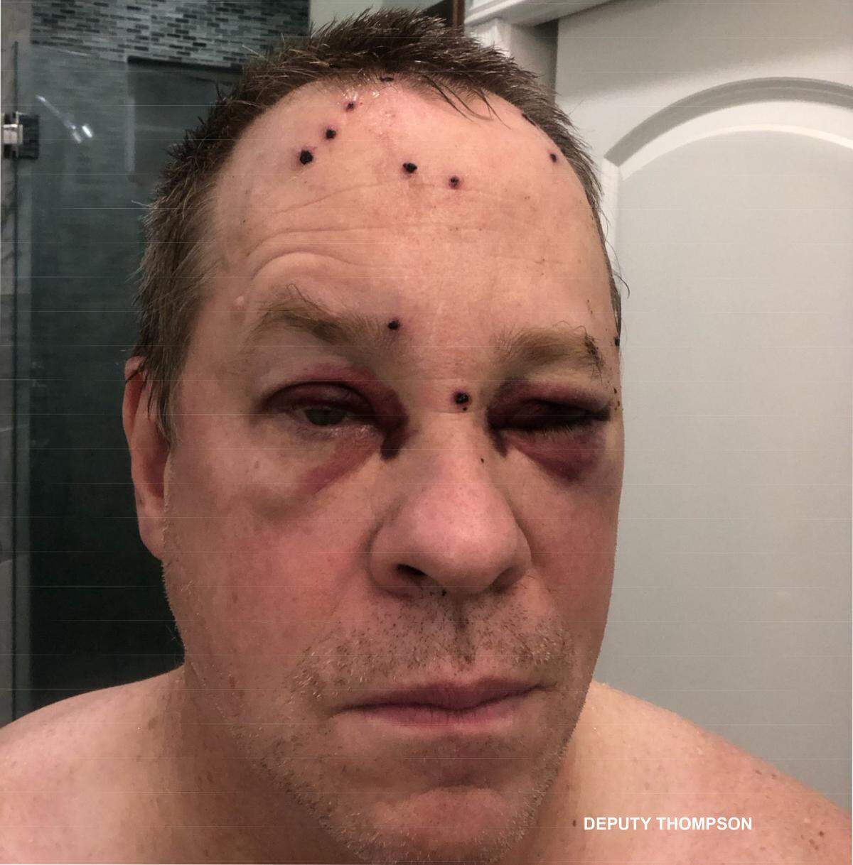 Whatcom County Sheriff’s Office Deputy Jason Thompson, who was one of two deputies shot in the line of duty on Feb. 10, had 12 or 13 pellets strike his face, many of which remain in his head three weeks later.