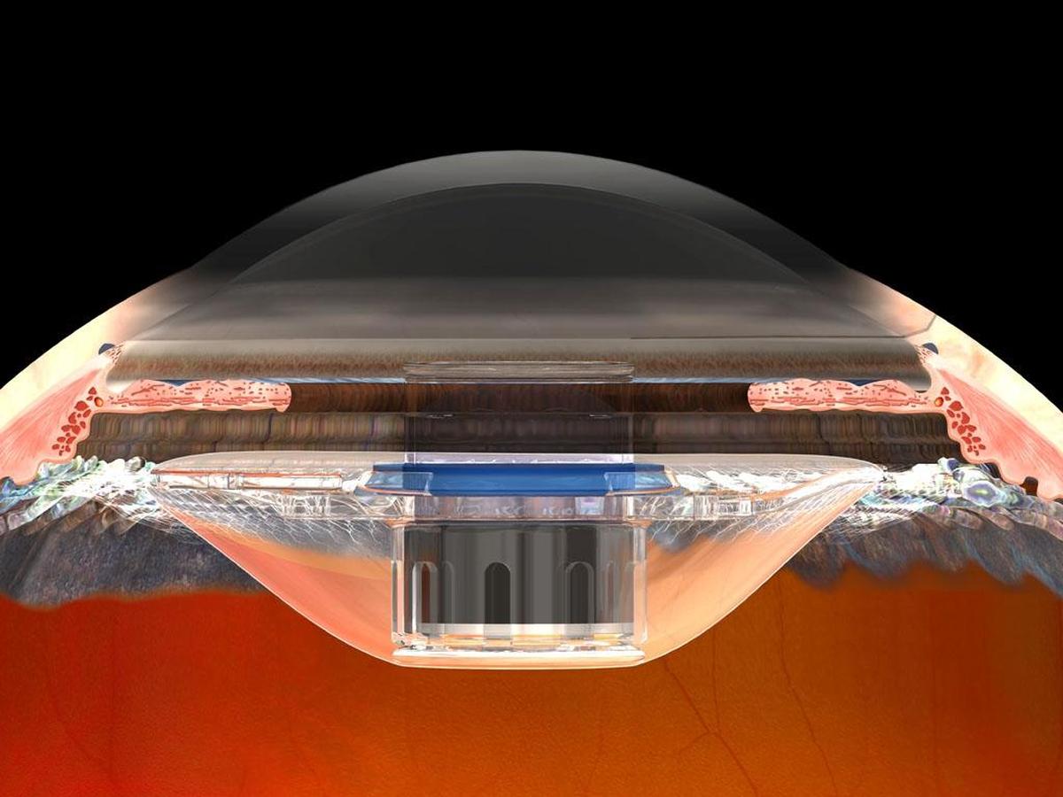 Surgeons are implanting the Implantable Miniature Telescope to help patients with age-related macular degeneration.