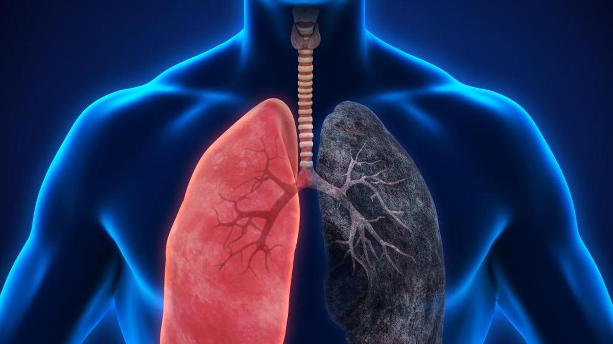 One of the leading causes of death in the United States is chronic obstructive pulmonary disease (COPD), and millions who have it likely don’t even know it, according to the National Heart, Lung and Blood Institute.