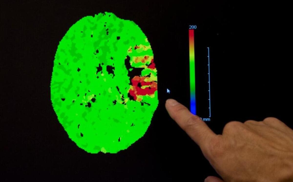 A graphic displaying the effected parts of a stroke patient’s brain is shown by Dr. George Luh at Mercy San Juan Medical Center in Sacramento, Calif.