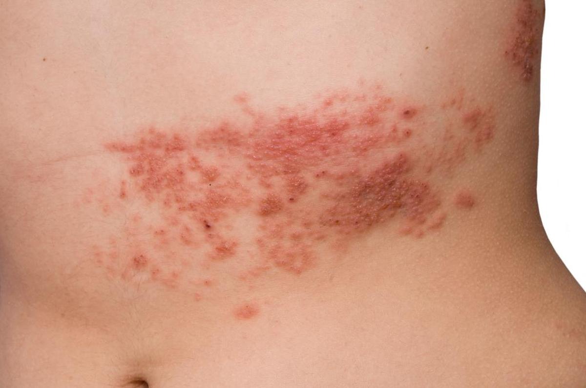 At least 1 million people a year in the United States get shingles, a painful and often debilitating skin rash, often with blisters, according to the Centers for Disease Control and Prevention.