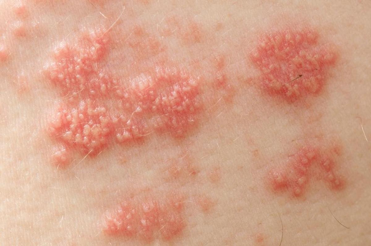 The shingles virus can appear as raised red bumps and blisters. There are anti-viral oral treatments available that can treat the infection, but they work best if taken within three days of the onset of the infection.