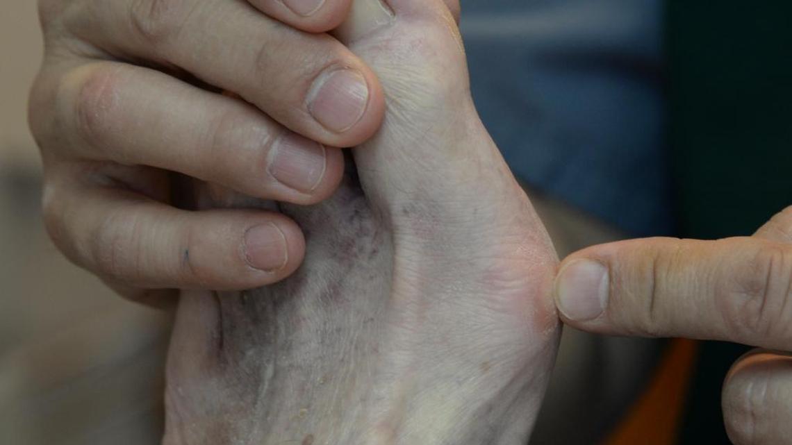 Podiatrist Dr. Michael Sherwin watches patients’ feet for common conditions, including bunions and hammer toes, corns and calluses, fungal toenails, pinched nerves on the balls of the feet known as Morton’s Neuroma, ingrown toenails, stress fractures, Gout and arch pain associated with flat feet and diabetes.