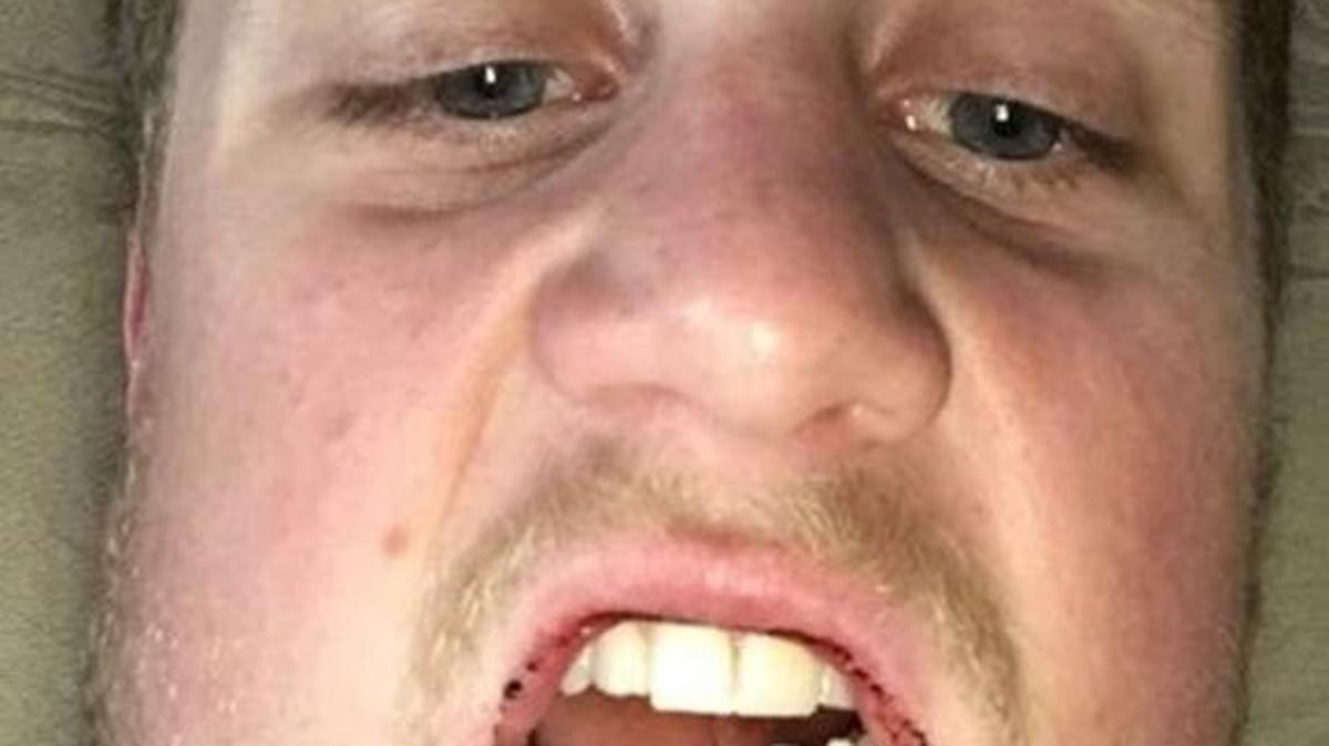 Justin O’Flaherty, 22, shows injuries to his jaw after he was punched early Sunday, May 8, in downtown Bellingham. He says the attackers called him a supporter of Donald Trump, the leading Republican presidential candidate.