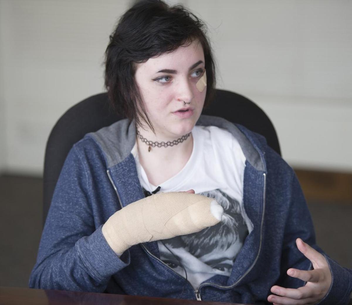 Plane crash survivor Autumn Veatch, 16, of Bellingham talks July 17, 2015, about surviving the plane crash that took the lives of her step grandparents in the Cascade Mountains. Her left hand was burned in the fire after the plane crash.